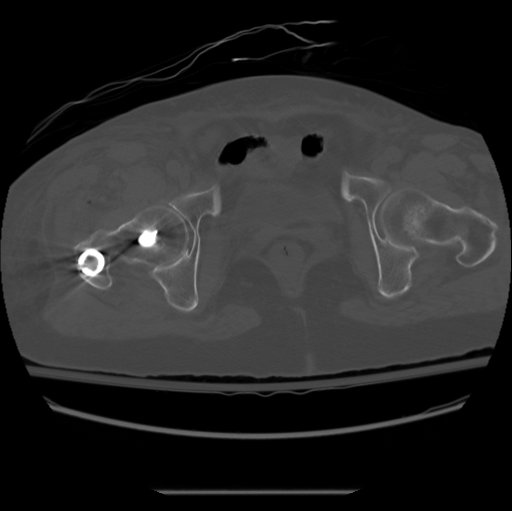 Femoral Nail Malrotation CT 1